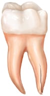 Vertical Root Fracture Vertical Root Fracture