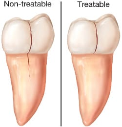 cracked-teeth cracked-teeth